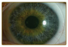 photo scleral
